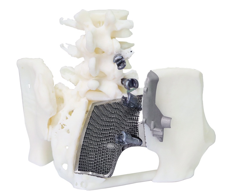 Титановый протез